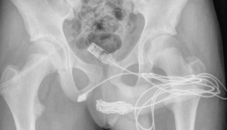 15-vjeçari përfundon në operacion pasi tenton të masë organin gjenital me një fishë USB
