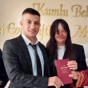 20 vjeçarja turke martohet me të dashurin që i hodhi acid në fytyrë