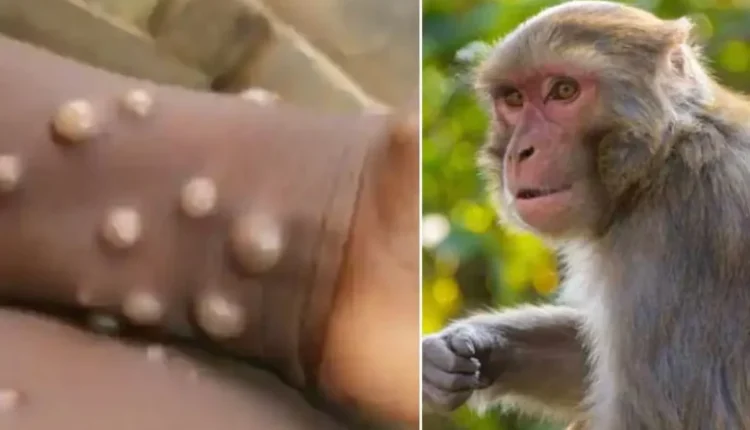 Lija e majmunit, OBSH shpall emergjencë globale shëndetësore