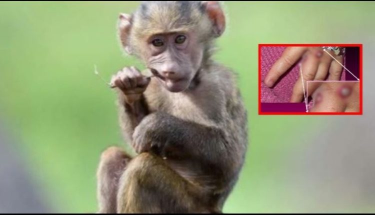 Frika nga lija e majmunëve, mbërrijnë në Shqipëri testet e para për diagnostikimin e rasteve