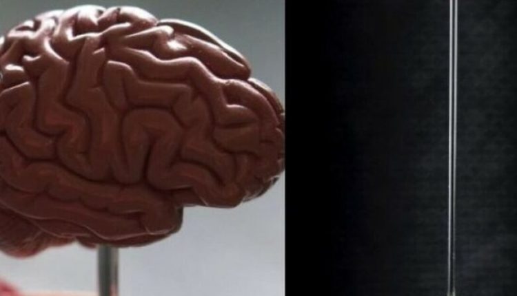 Historia e rrallë/ E moshura zbulon se ka jetuar me një gjilpërë metalike në tru, dyshohet se ia kanë vendosur prindërit